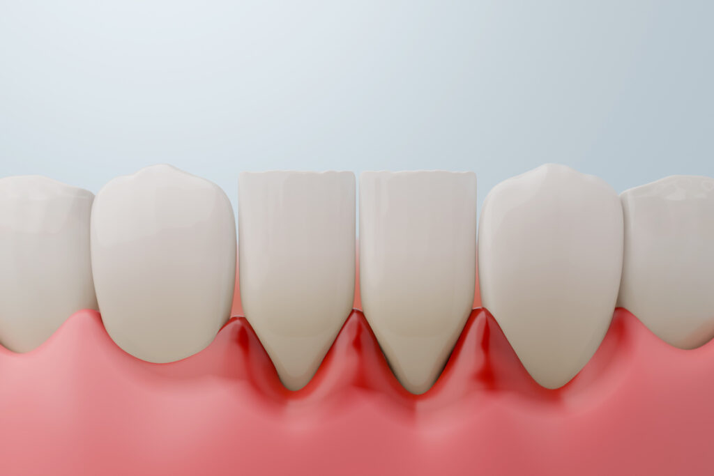 Lower front teeth with severe periodontitis and gum recession.