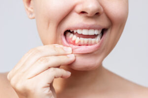 A red lump on the gum near the tooth. Gingivitis, gum inflammation. Cropped shot of a young woman showing red inflamed gums isolated on a white background. Close up. Dentistry, dental care