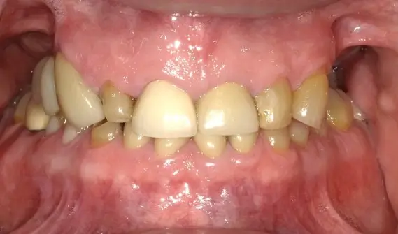 Patient 1 before - Middlesex Periodontics & Dental Implants