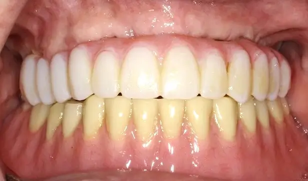 Patient 2 after - Middlesex Periodontics & Dental Implants