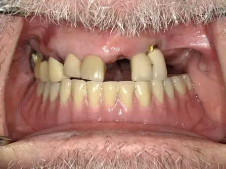 Patient 2 before - Middlesex Periodontics & Dental Implants