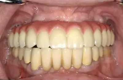Patient 3 after - Middlesex Periodontics & Dental Implants