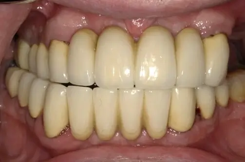 Patient 3 before - Middlesex Periodontics & Dental Implants