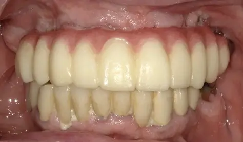 Patient 4 after - Middlesex Periodontics & Dental Implants