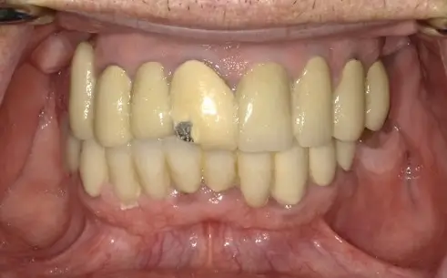 Patient 4 before - Middlesex Periodontics & Dental Implants