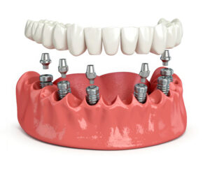 Full arch on implants: abutments and installation of a bridge prosthesis