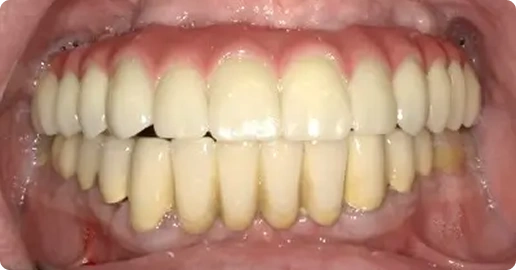 after img - Middlesex Periodontics & Dental Implants