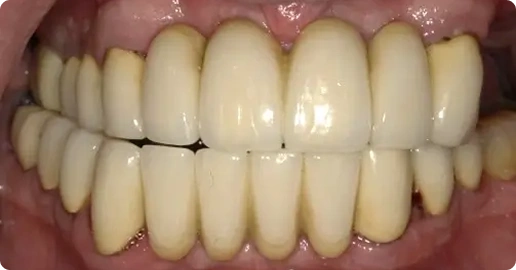 before img - Middlesex Periodontics & Dental Implants