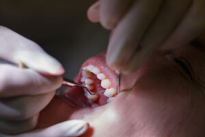 Patient at dentists office, getting soft-tissue probed and teeth cleaned of tartar and plaque, preventing periodontal disease. Dental hygiene, painful procedures and prevention concept.