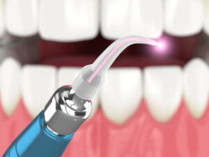3d render of dental diode laser used to treat gums. The concept of using laser therapy in the treatment of gums