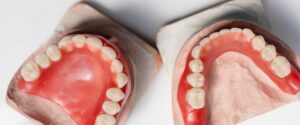 Ceramic dental dentures of the upper and lower jaws