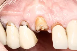 Dental Implant case tooth before immediate implant
