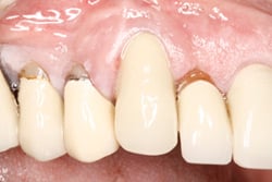 Dental Implant Case tooth 2 weeks after immediate implant