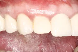 area of immediate implant one week after surgery