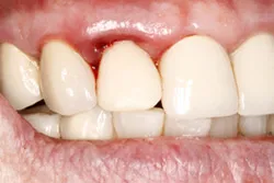 tooth after immediate implant