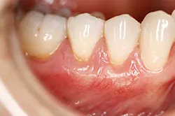 Gum Grafting Case after gum grafting photo